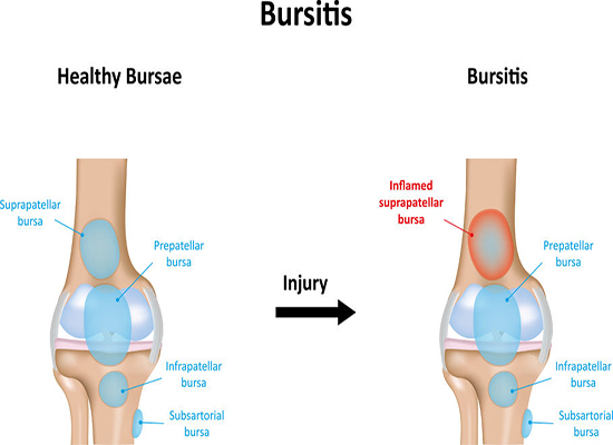 Bursitis- Causes and Treatments Joint Inflamation