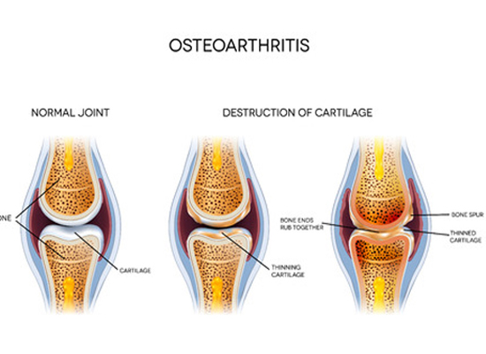 Chondroitin and Glucosamine Osteoarthritis 